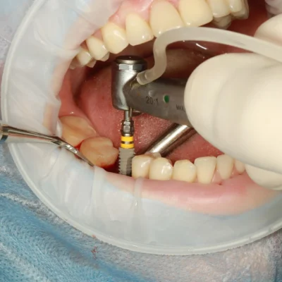 dental implant hurt