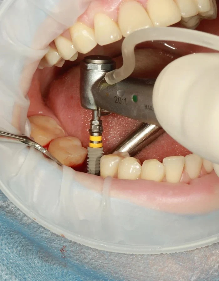 dental implant hurt