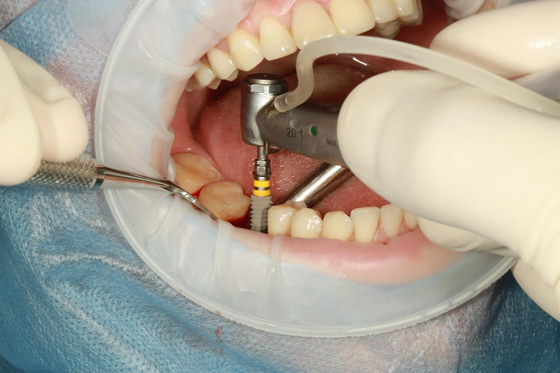 dental implant hurt